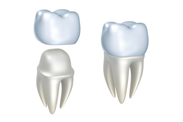 Dental Crowns